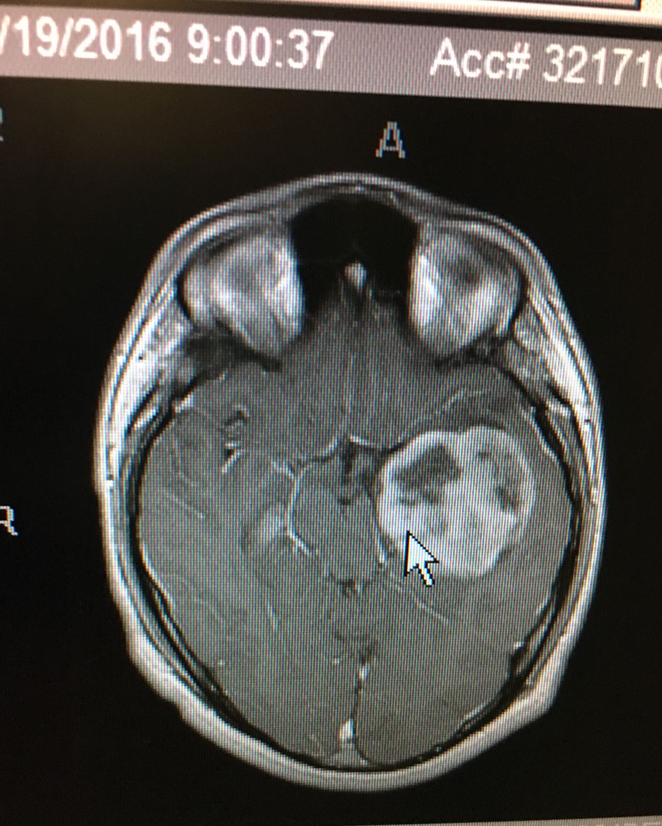 A positive life after cancer treatment (tumor)